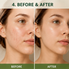 EvoraCare 15% Anti Acne Face Serum.