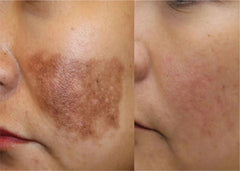 Pigmentation